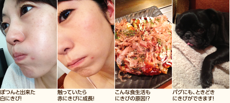 画像:大人にきび